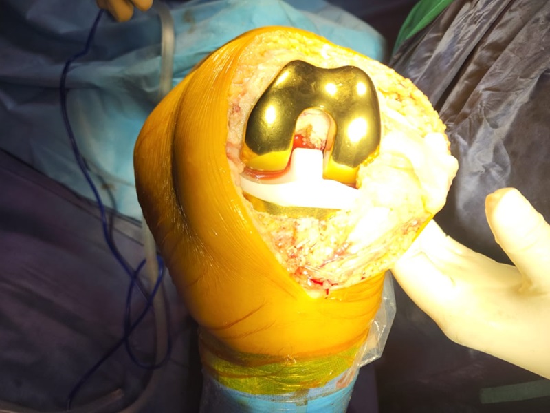 total knee replacement (gold knee implant) in Mandi HP